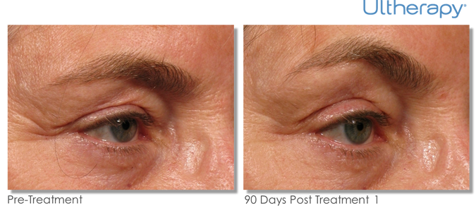 ultherapy-before-and-after-photos-Eyes.png