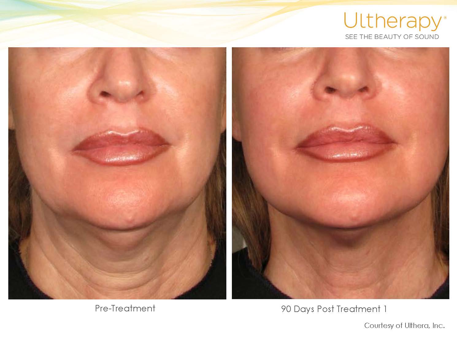 ultherapy-before-and-after_Page_36.jpg